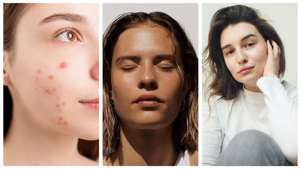 6 Skin Problems That Arent Treatable With Any Skincare Products 1000x563 1